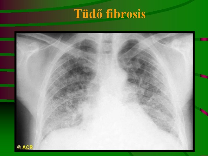 Tüdő fibrosis 