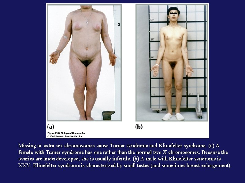 Missing or extra sex chromosomes cause Turner syndrome and Klinefelter syndrome. (a) A female