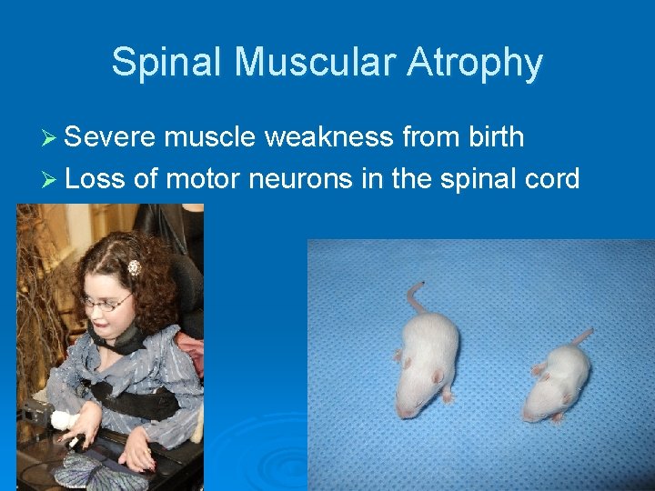 Spinal Muscular Atrophy Ø Severe muscle weakness from birth Ø Loss of motor neurons