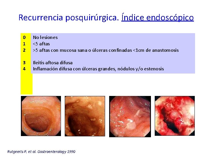 Recurrencia posquirúrgica. Índice endoscópico 0 1 2 No lesiones <5 aftas >5 aftas con