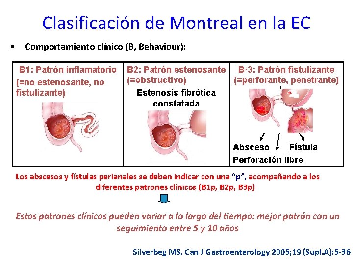 Clasificación de Montreal en la EC § Comportamiento clínico (B, Behaviour): B 1: Patrón