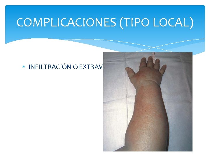 COMPLICACIONES (TIPO LOCAL) INFILTRACIÓN O EXTRAVASACIÓN 