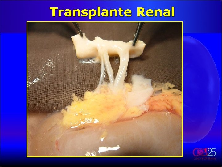 Transplante Renal 