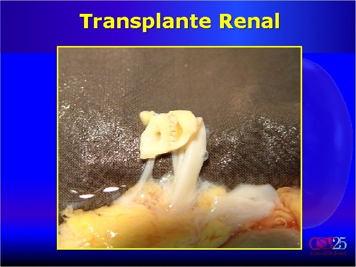 Transplante Renal 