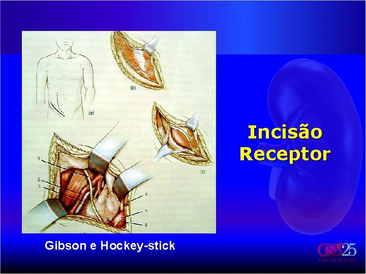 Incisão Receptor Gibson e Hockey-stick 