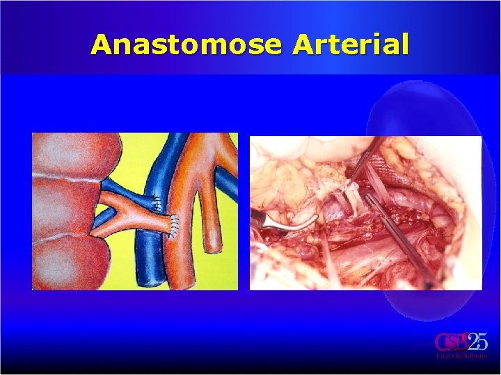 Anastomose Arterial 