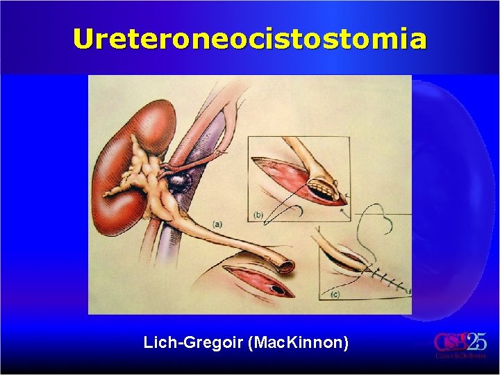 Ureteroneocistostomia Lich-Gregoir (Mac. Kinnon) 