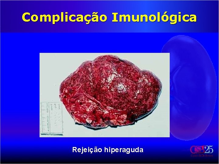 Complicação Imunológica Rejeição hiperaguda 