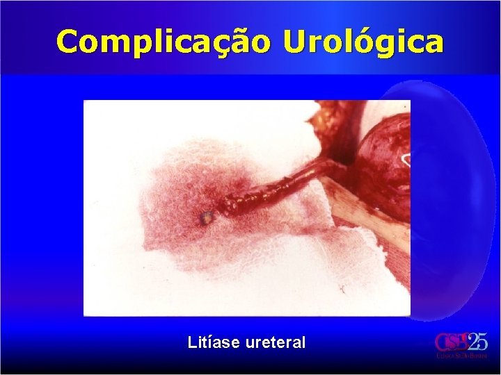 Complicação Urológica Litíase ureteral 