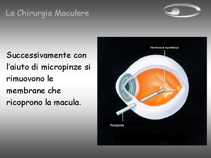 La Chirurgia Maculare Successivamente con l’aiuto di micropinze si rimuovono le membrane che ricoprono