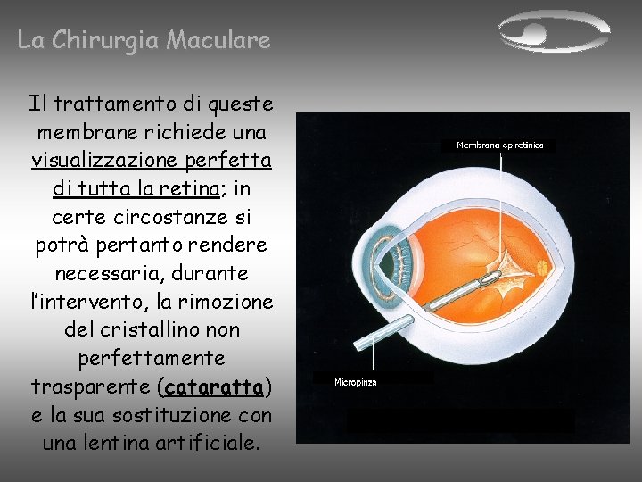 La Chirurgia Maculare Il trattamento di queste membrane richiede una visualizzazione perfetta di tutta