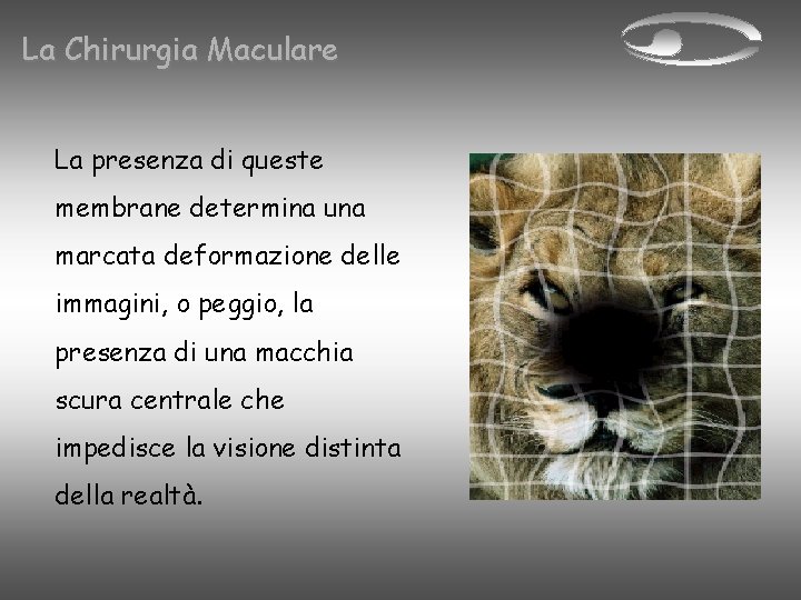 La Chirurgia Maculare La presenza di queste membrane determina una marcata deformazione delle immagini,