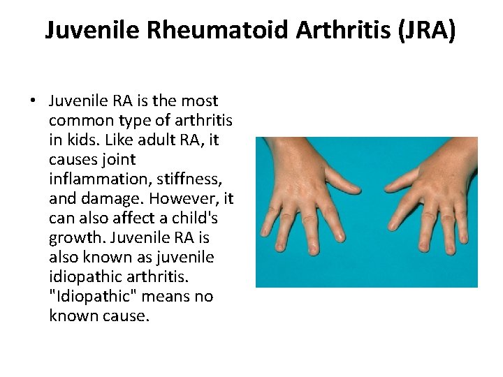 Juvenile Rheumatoid Arthritis (JRA) • Juvenile RA is the most common type of arthritis