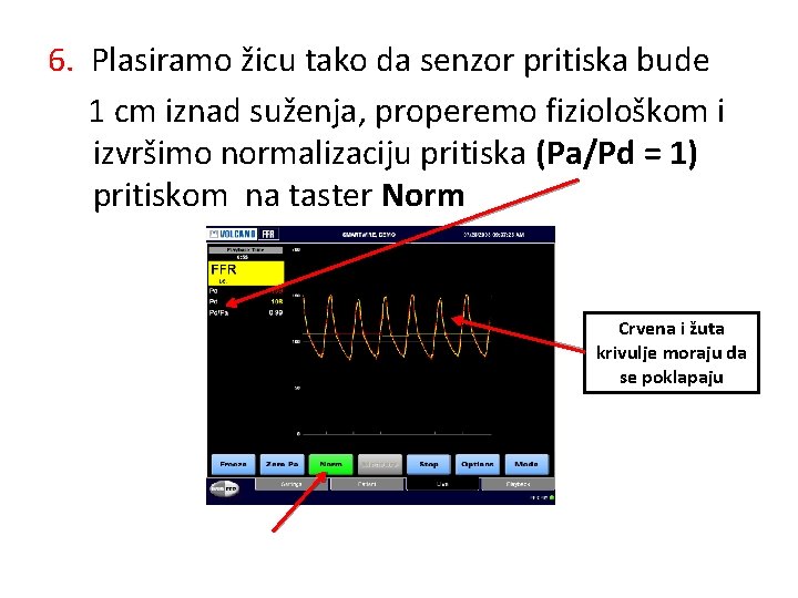 6. Plasiramo žicu tako da senzor pritiska bude 1 cm iznad suženja, properemo fiziološkom