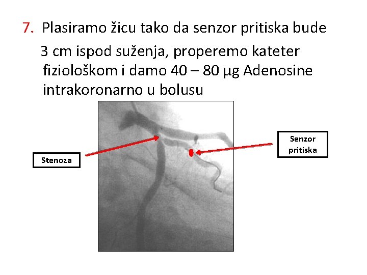 7. Plasiramo žicu tako da senzor pritiska bude 3 cm ispod suženja, properemo kateter