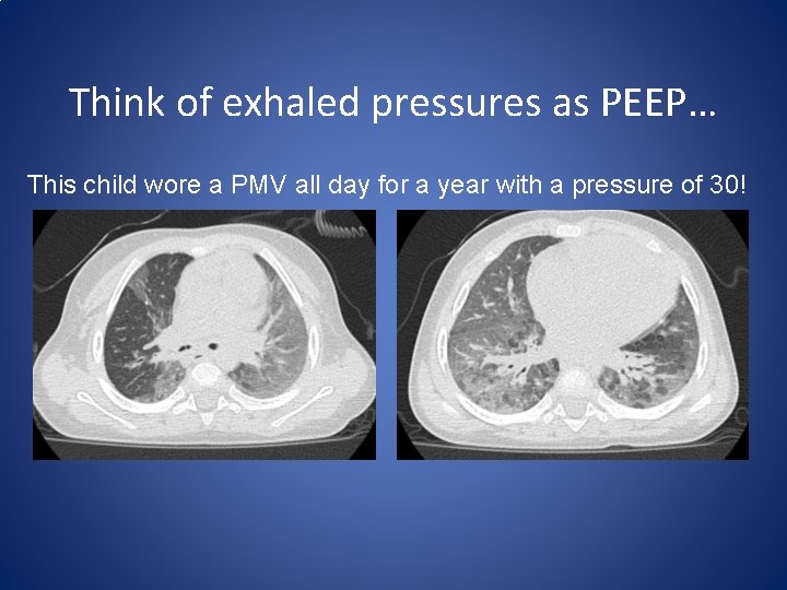 Think of exhaled pressures as PEEP… This child wore a PMV all day for