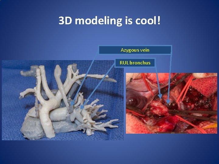 3 D modeling is cool! Azygous vein RUL bronchus 