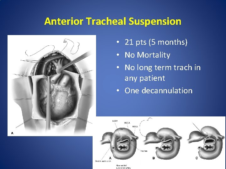 Anterior Tracheal Suspension • 21 pts (5 months) • No Mortality • No long