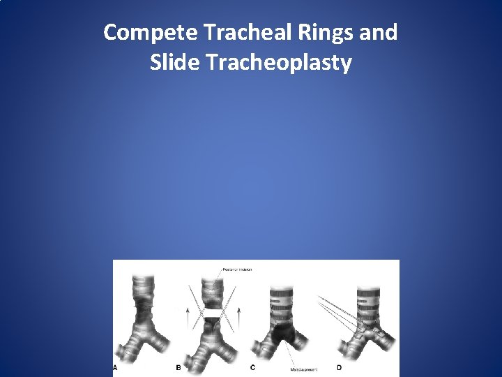 Compete Tracheal Rings and Slide Tracheoplasty 