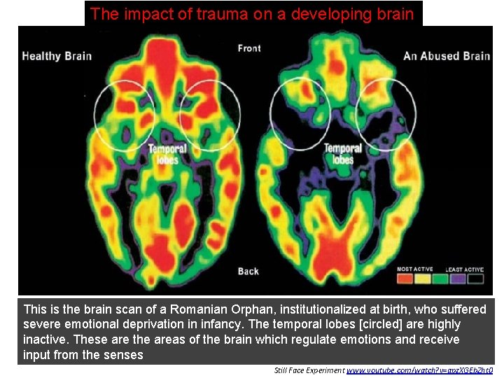 The impact of trauma on a developing brain This is the brain scan of