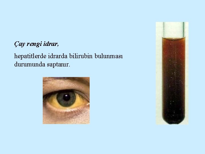 Çay rengi idrar, hepatitlerde idrarda bilirubin bulunması durumunda saptanır. 