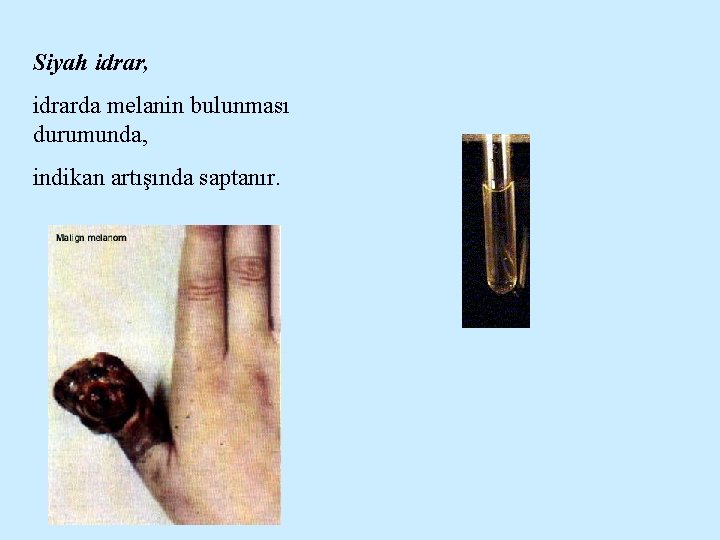Siyah idrar, idrarda melanin bulunması durumunda, indikan artışında saptanır. 