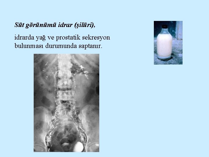 Süt görünümü idrar (şilüri), idrarda yağ ve prostatik sekresyon bulunması durumunda saptanır. 
