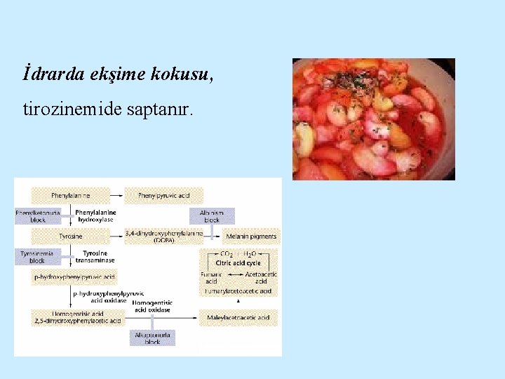 İdrarda ekşime kokusu, tirozinemide saptanır. 