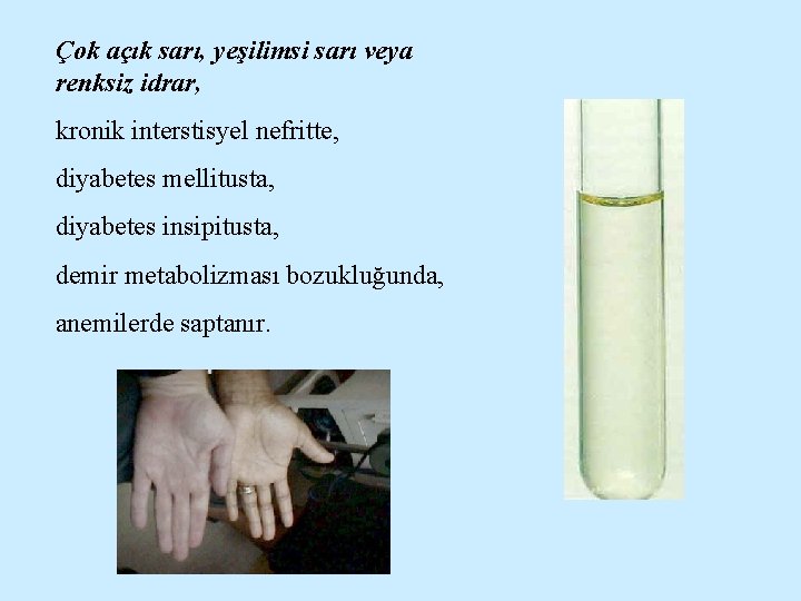 Çok açık sarı, yeşilimsi sarı veya renksiz idrar, kronik interstisyel nefritte, diyabetes mellitusta, diyabetes