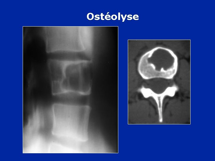 Ostéolyse 