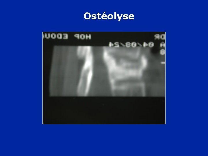 Ostéolyse 