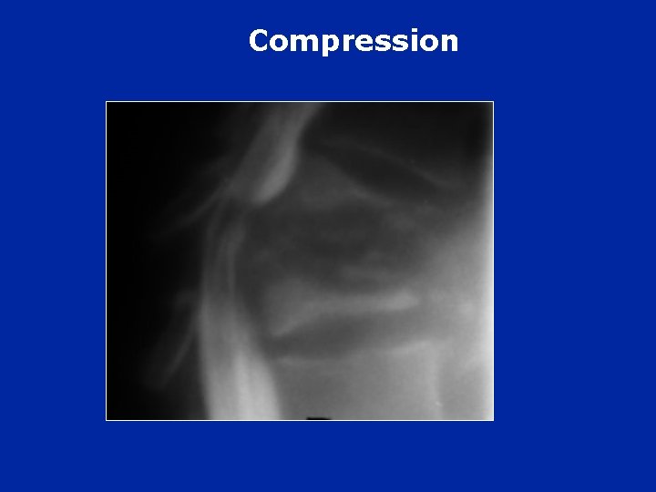 Compression 