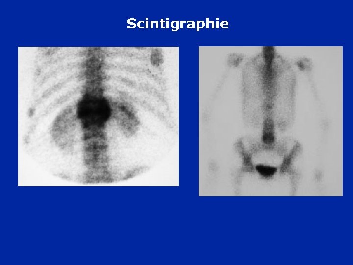 Scintigraphie « ostéite aspécifique » 