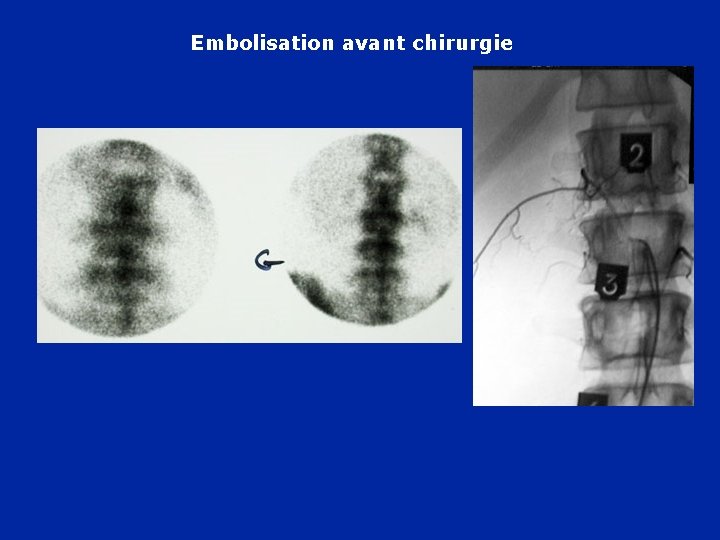 Embolisation avant chirurgie 