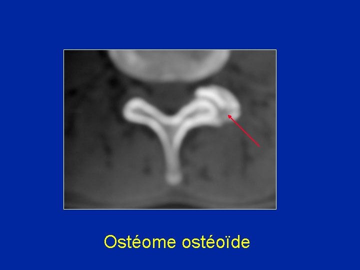 Ostéome ostéoïde 