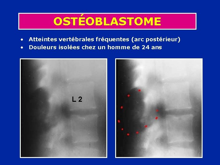 OSTÉOBLASTOME • Atteintes vertébrales fréquentes (arc postérieur) • Douleurs isolées chez un homme de