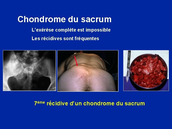 Chondrome du sacrum L’exérèse complète est impossible Les récidives sont fréquentes 7ème récidive d’un