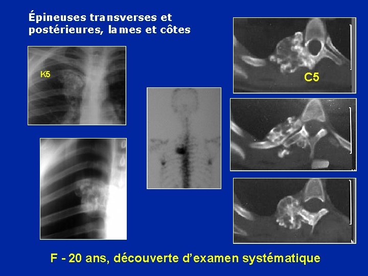 Épineuses transverses et postérieures, lames et côtes K 5 C 5 F - 20