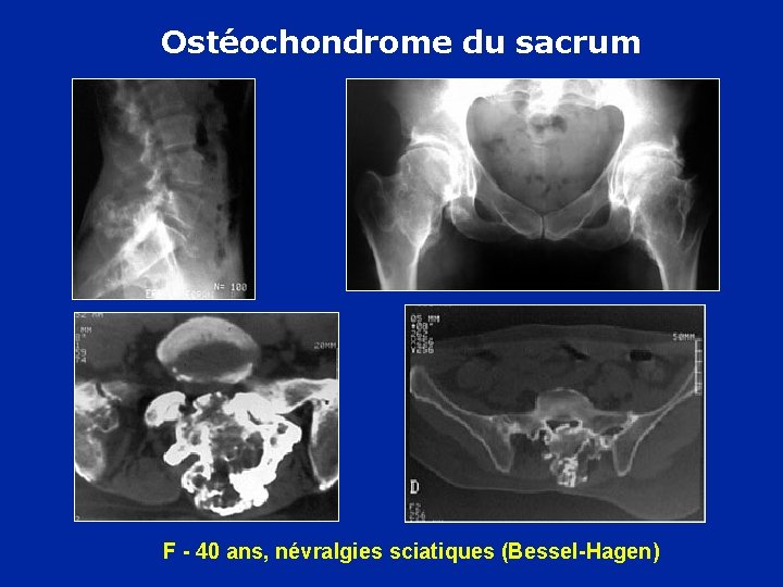 Ostéochondrome du sacrum F - 40 ans, névralgies sciatiques (Bessel-Hagen) 