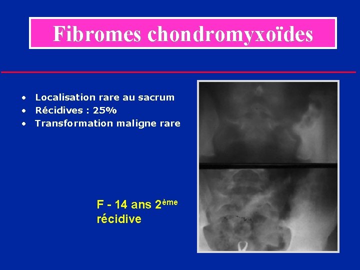 Fibromes chondromyxoïdes • Localisation rare au sacrum • Récidives : 25% • Transformation maligne
