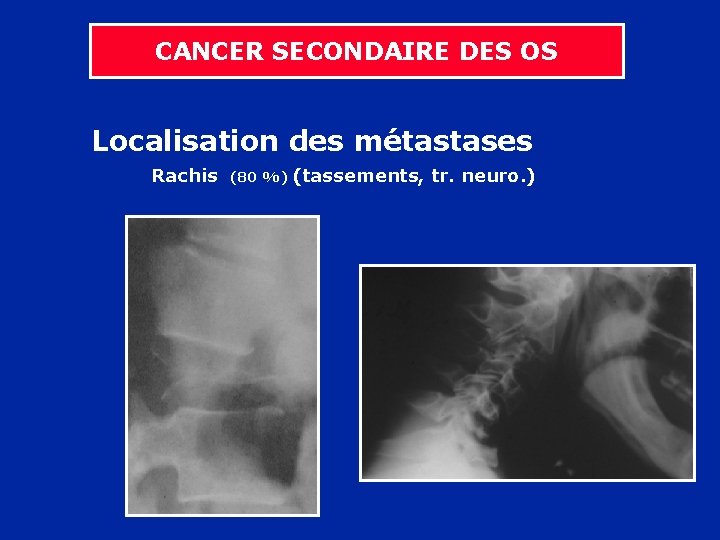 CANCER SECONDAIRE DES OS Localisation des métastases Rachis (80 %) (tassements, tr. neuro. )