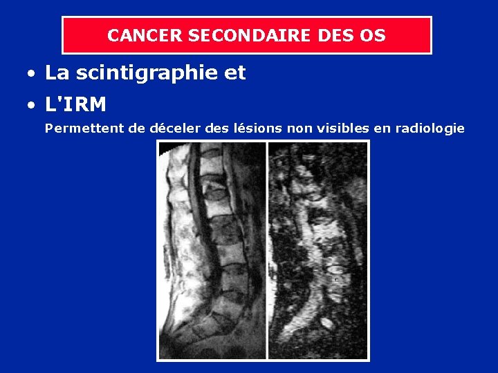 CANCER SECONDAIRE DES OS • La scintigraphie et • L'IRM Permettent de déceler des