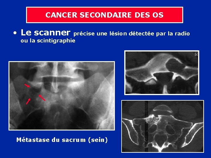 CANCER SECONDAIRE DES OS • Le scanner précise une lésion détectée par la radio