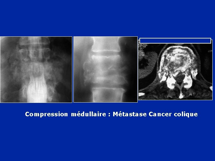 Compression médullaire : Métastase Cancer colique 