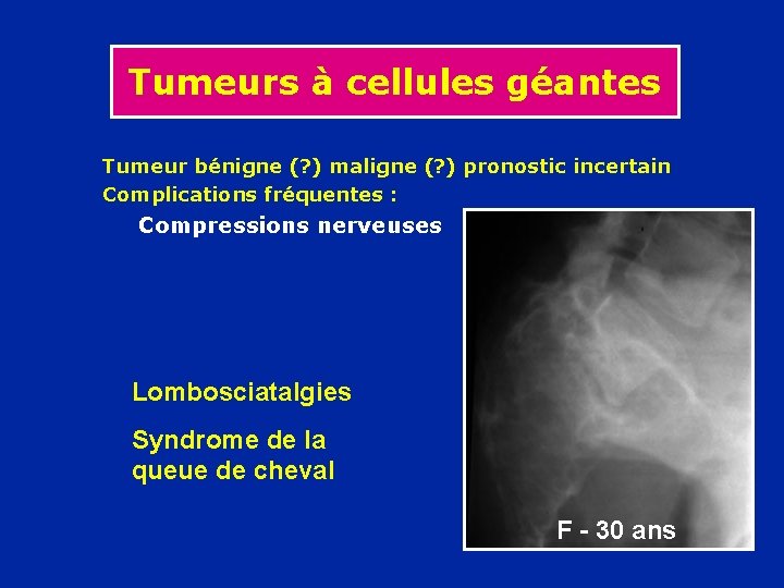 Tumeurs à cellules géantes Tumeur bénigne (? ) maligne (? ) pronostic incertain Complications