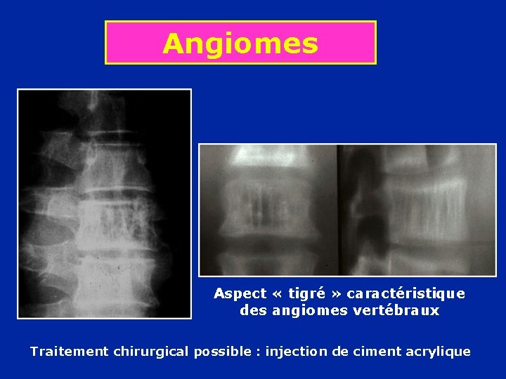 Angiomes Aspect « tigré » caractéristique des angiomes vertébraux Traitement chirurgical possible : injection