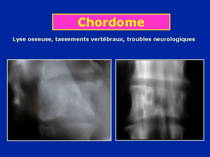 Chordome Lyse osseuse, tassements vertébraux, troubles neurologiques 