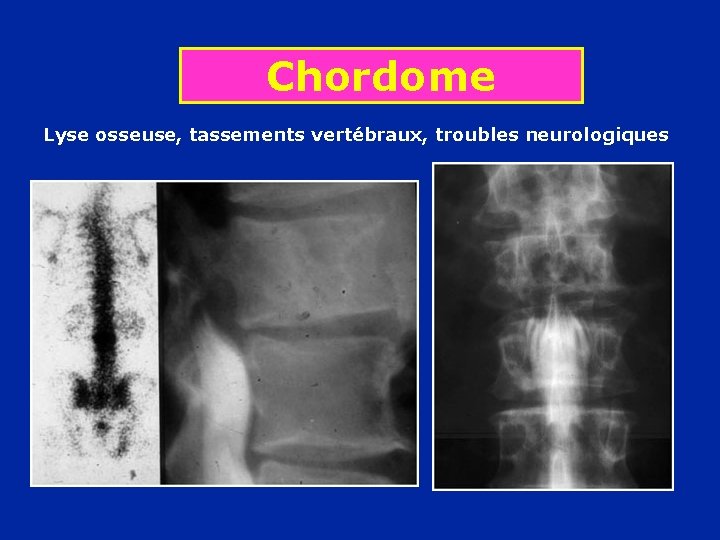 Chordome Lyse osseuse, tassements vertébraux, troubles neurologiques 