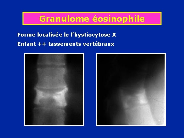 Granulome éosinophile Forme localisée le l’hystiocytose X Enfant ++ tassements vertébraux 