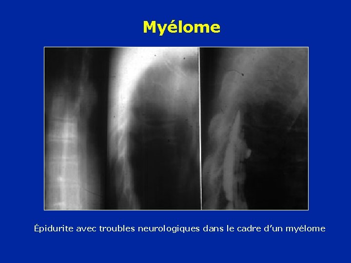 Myélome Épidurite avec troubles neurologiques dans le cadre d’un myélome 